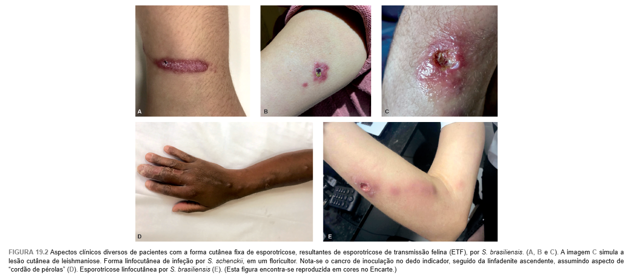 Sintomas Esporotricose em humanos:causas e tratamento